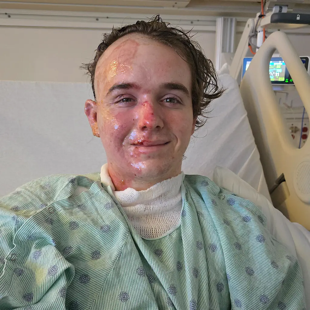 Jacob sustained burns to the side of his face, neck, right arm, and back. Credit: GoFundMe