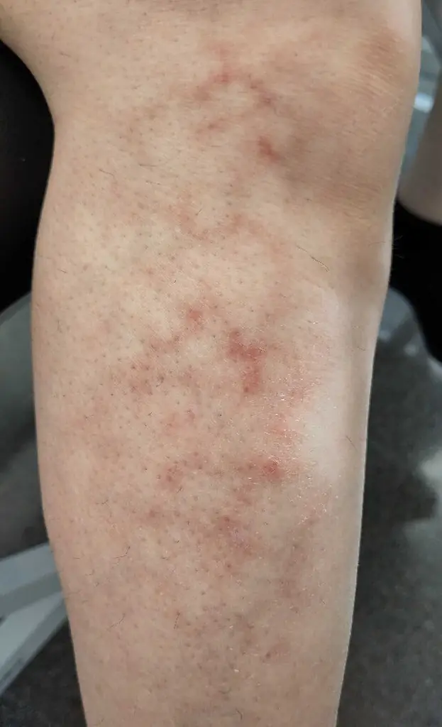  Toasted skin syndrome. (stock image) Credit: Jmarchn/Wikimedia Commons