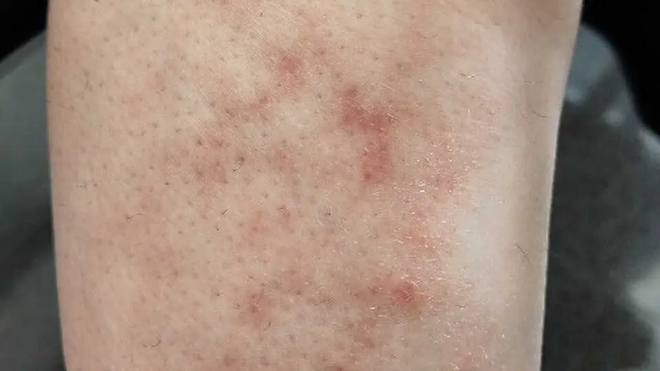 Erythema_ab_igne,_right_leg.jpg
