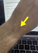 Reason why so many people seem to have the exact same freckle in the exact same place