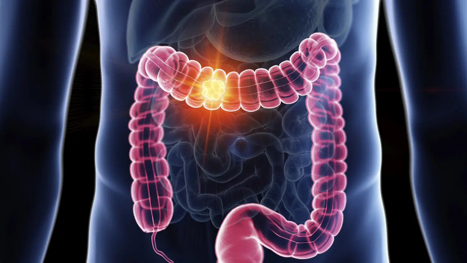 Colon cancer is one of the most common in those under 50. Credit: Getty Stock Images