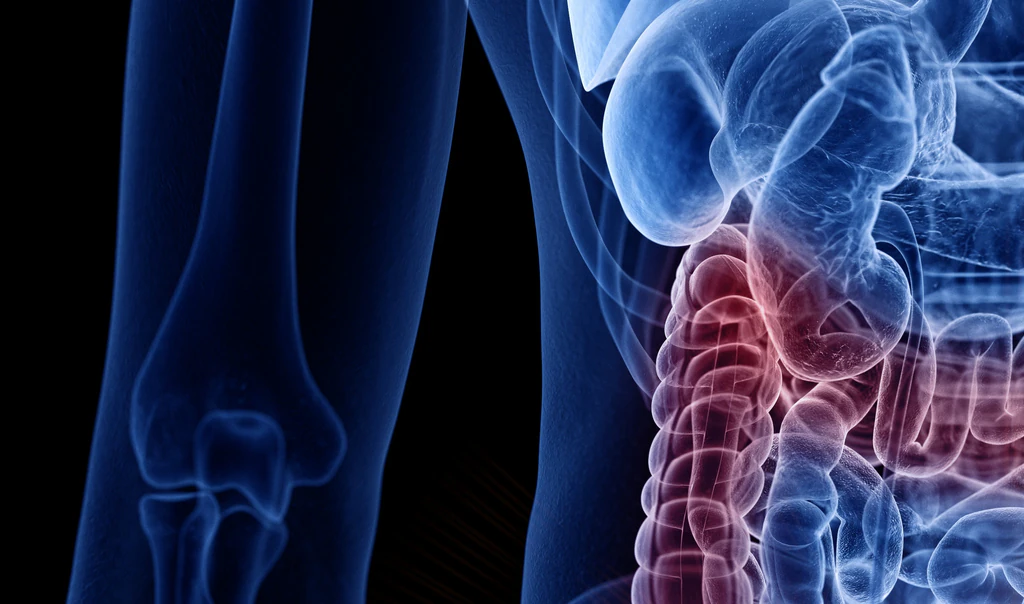 Woman diagnosed with stage 4 bowel cancer shares the four easy-to-miss symptoms she experienced