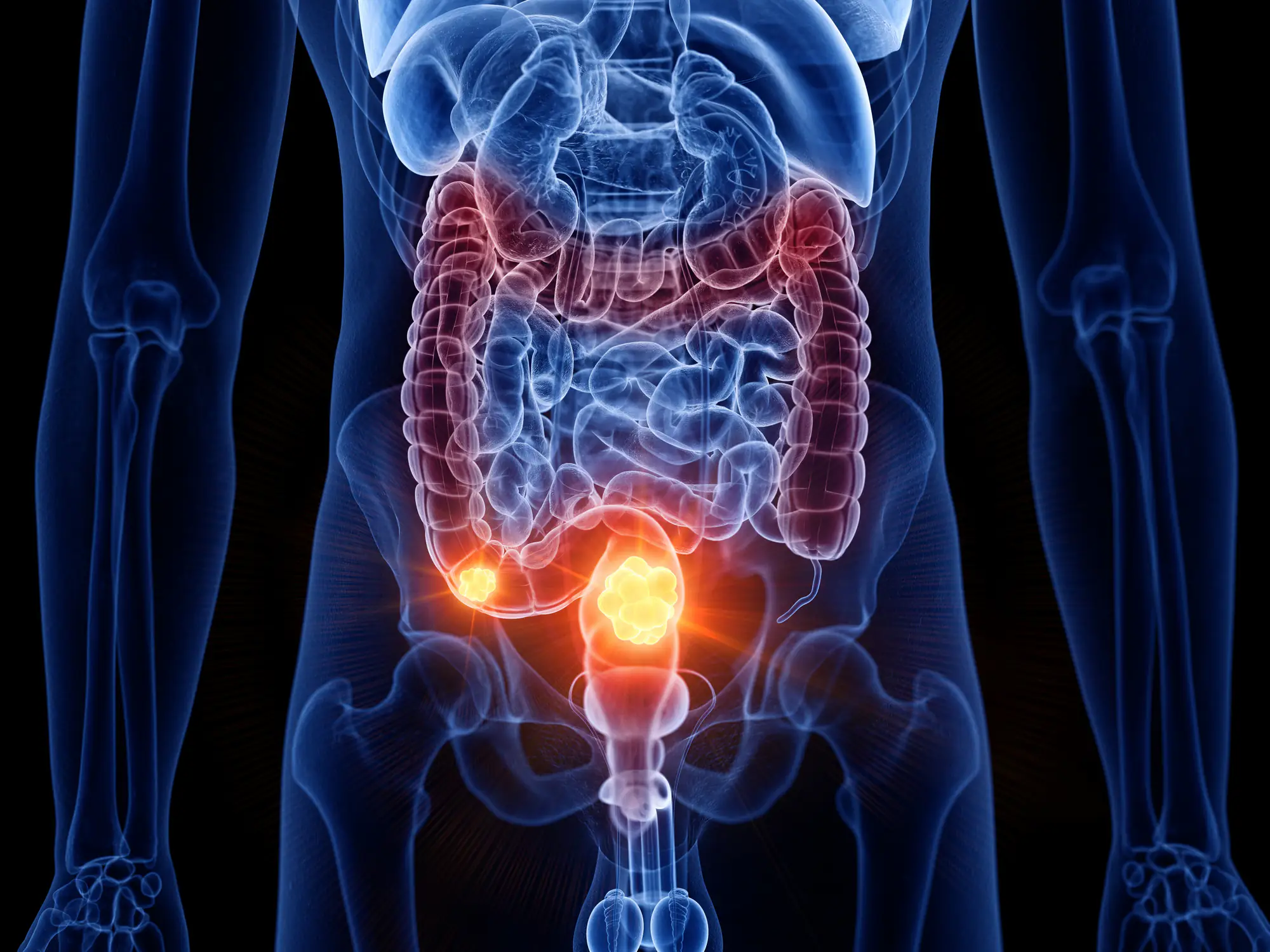 Woman diagnosed with stage 4 bowel cancer shares the four easy-to-miss symptoms she experienced