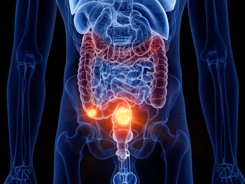 Woman diagnosed with stage 4 bowel cancer shares the four easy-to-miss symptoms she experienced