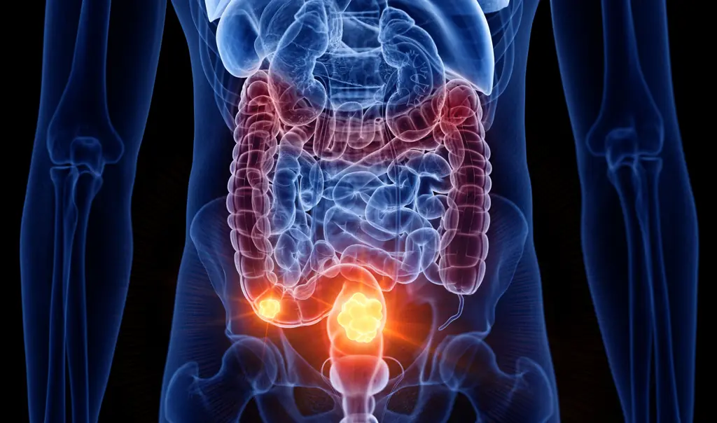 Woman diagnosed with stage 4 bowel cancer shares the four easy-to-miss symptoms she experienced
