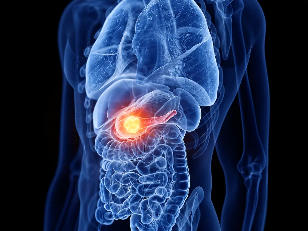 Pancreatic cancer is among the most deadly forms of the disease. Credit:	SEBASTIAN KAULITZKI/SCIENCE PHOTO LIBRARY