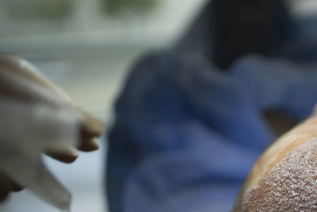 Man, 38, dies after undergoing hair transplant overseas - police investigation launched