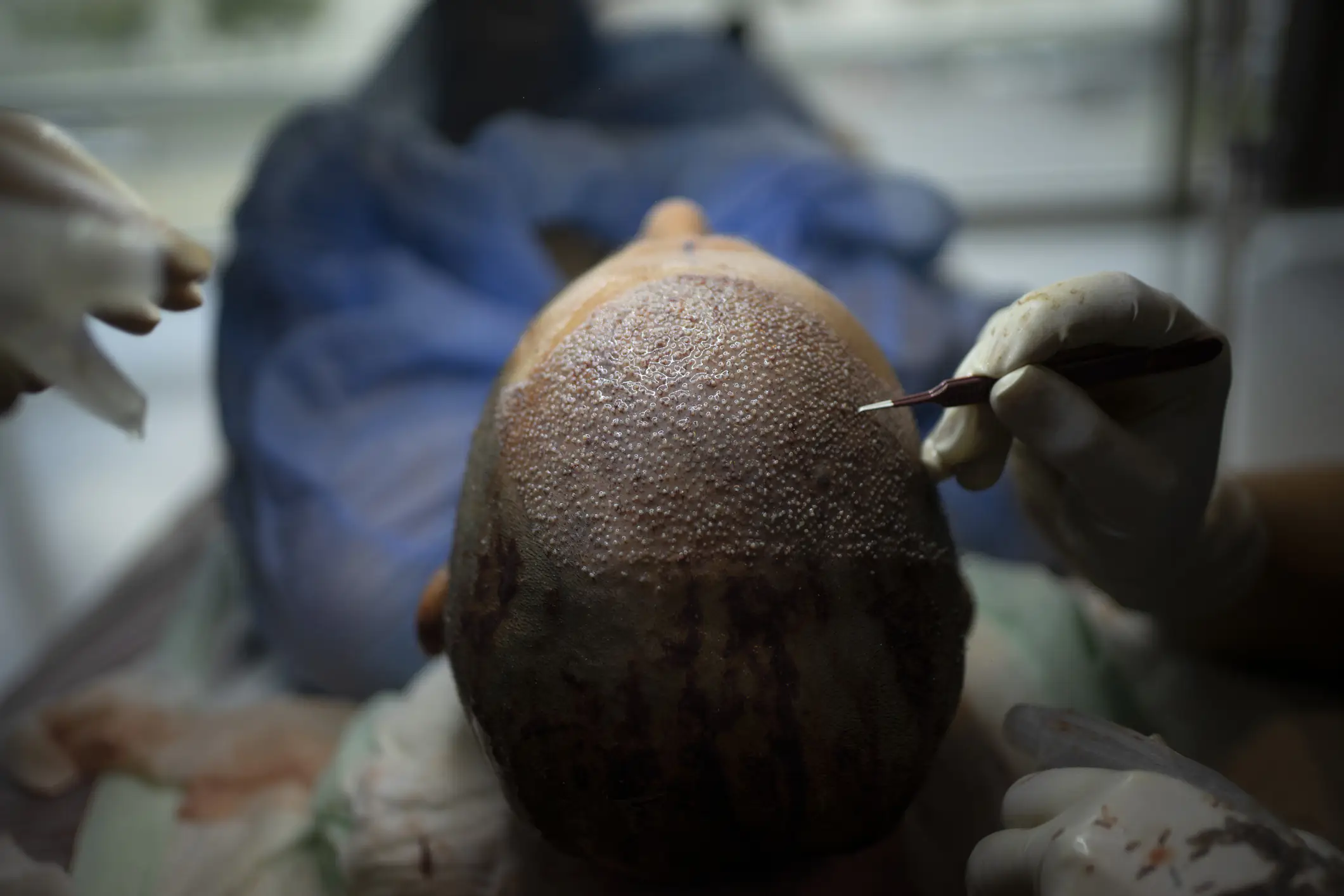 Man, 38, dies after undergoing hair transplant overseas - police investigation launched