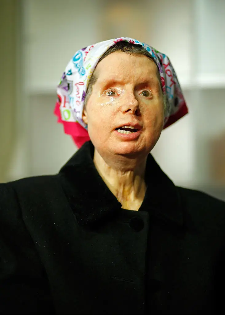 Carla Nash was attacked by a chimpanzee in  2009. Credit: MediaNews Group/Boston Herald via Getty Images 