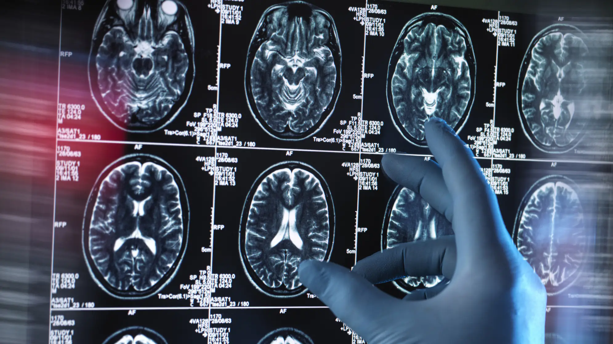 Brain scan