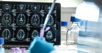 Scientists discover that Alzheimer's can be passed from person to person in groundbreaking study