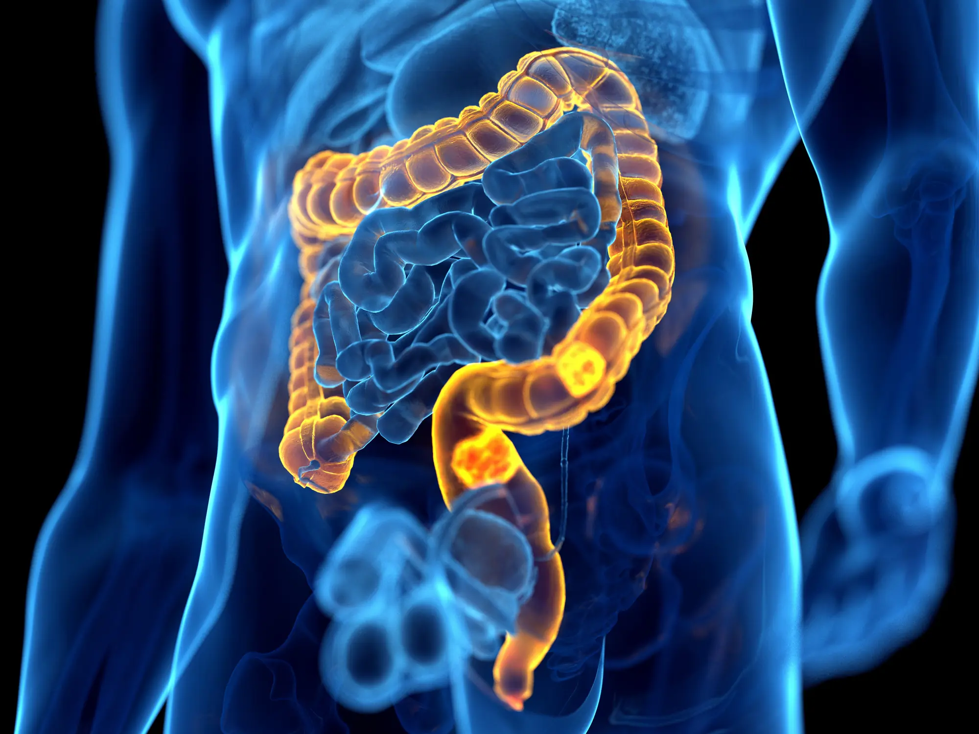 Colorectal cancer is increasingly being diagnosed in younger people. Credit: SEBASTIAN KAULITZKI/SCIENCE PHOTO LIBRARY/Getty Images