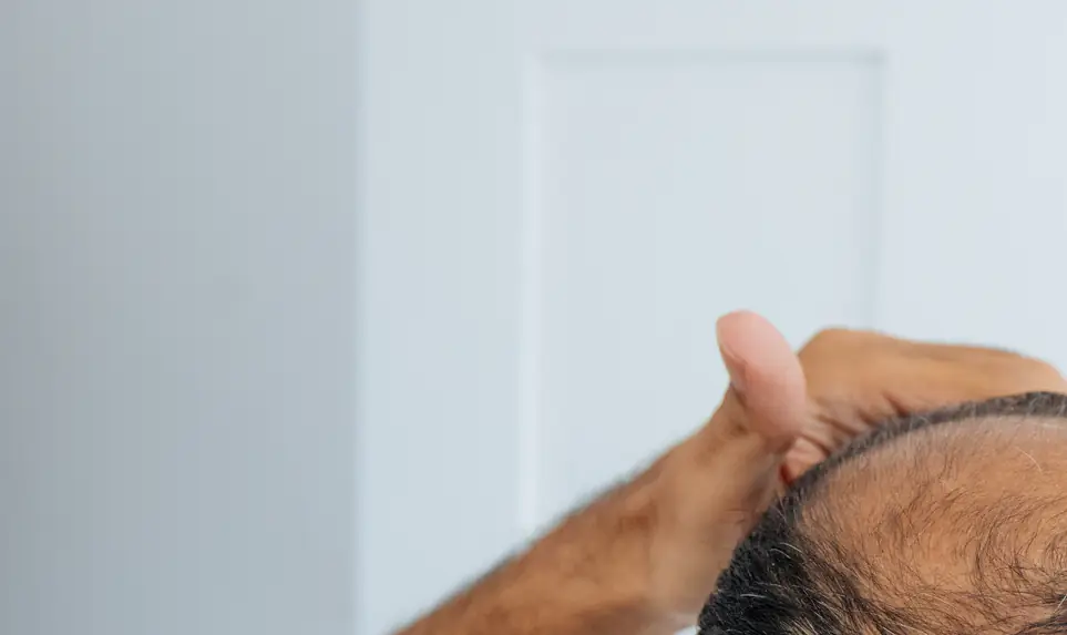 Scientists claim we may now have a cure for baldness