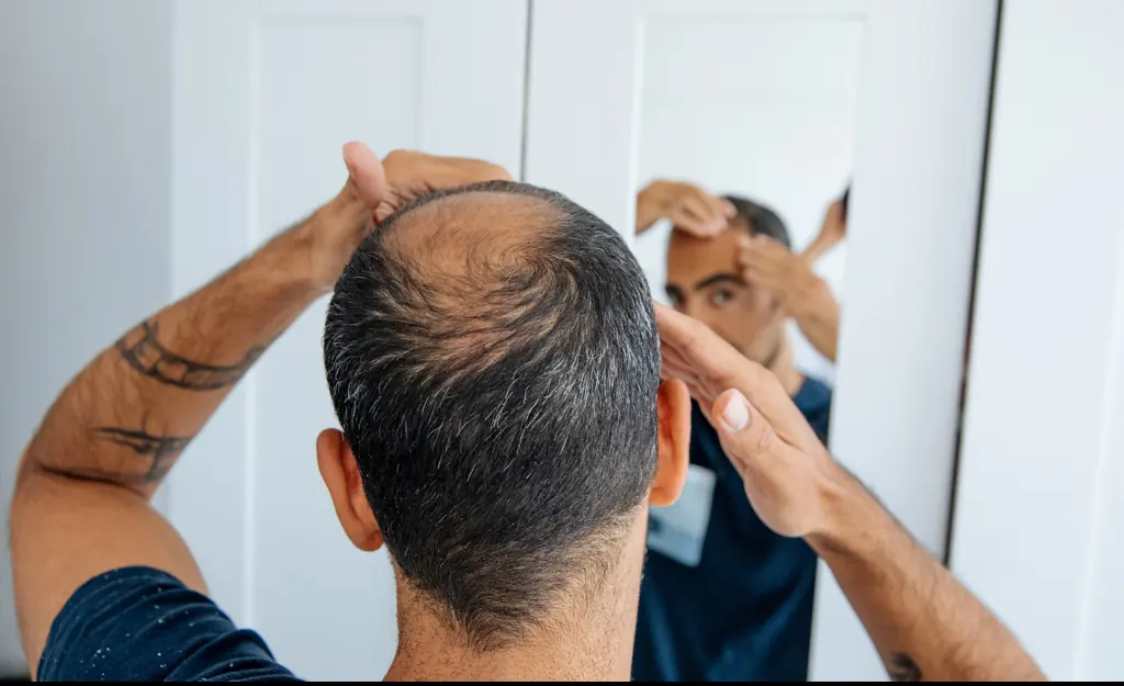 Man left with swollen head following hair transplant shows off results