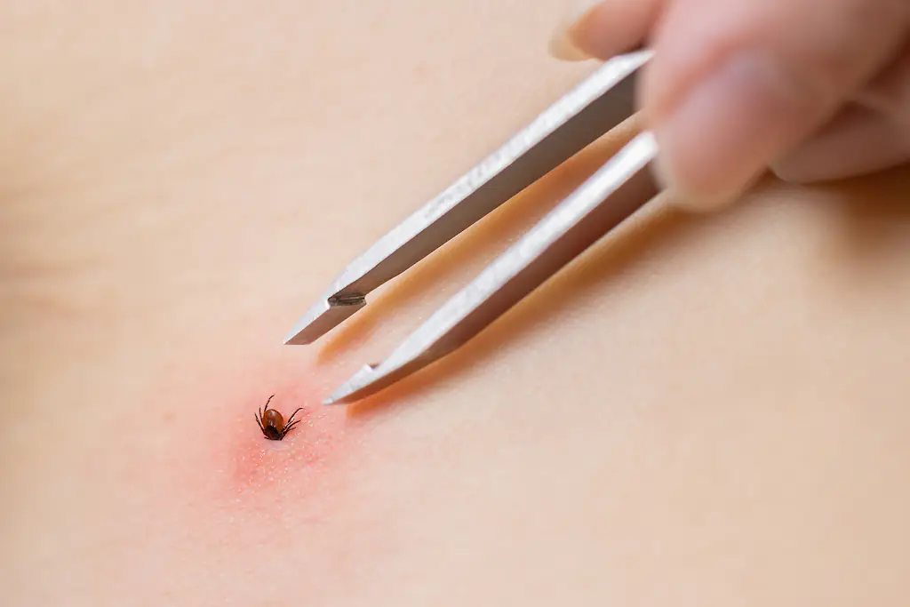 Lyme disease is transmitted through infected tick bites. Credit: rbkomar / Getty