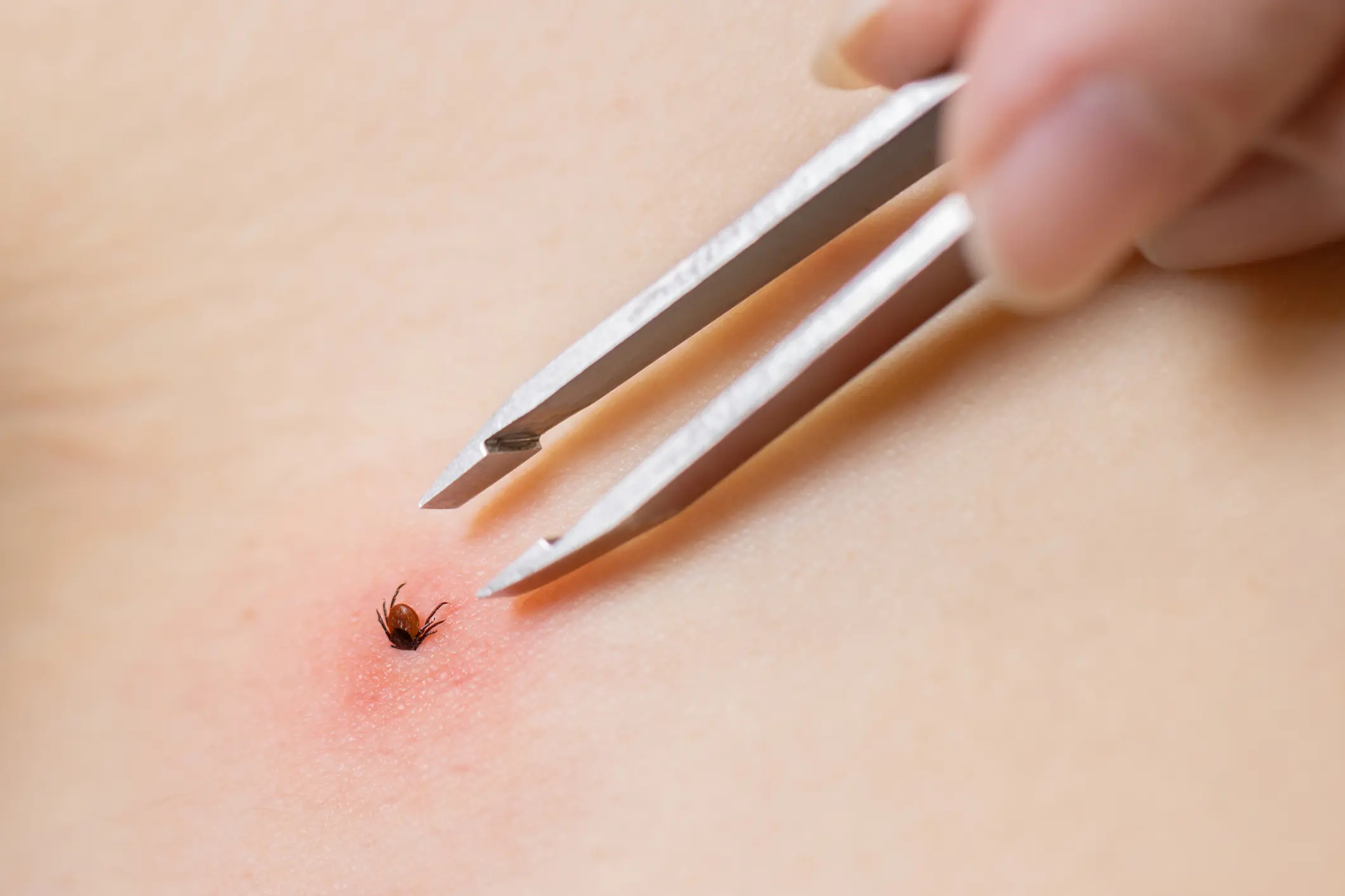 Doctors say people who have been bitten by a tick don’t need to get tested for antibodies to alpha-gal unless they have symptoms. Credit: rbkomar / Getty