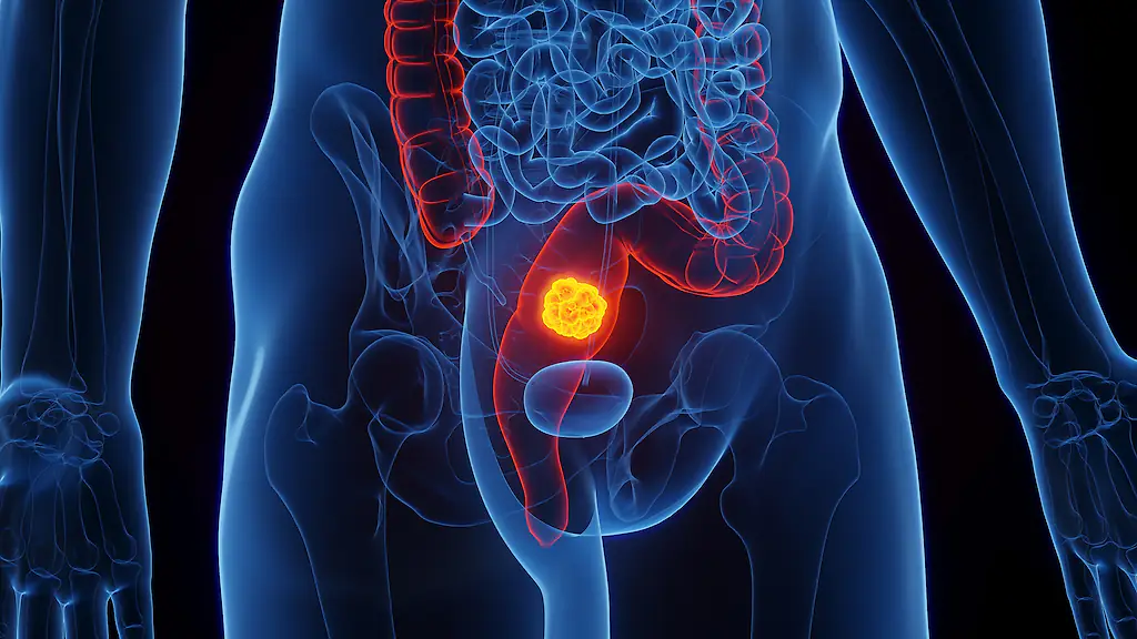 Bowel cancer appears to be on the rise. Credit: SEBASTIAN KAULITZKI/SCIENCE PHOTO LIBRARY / Getty