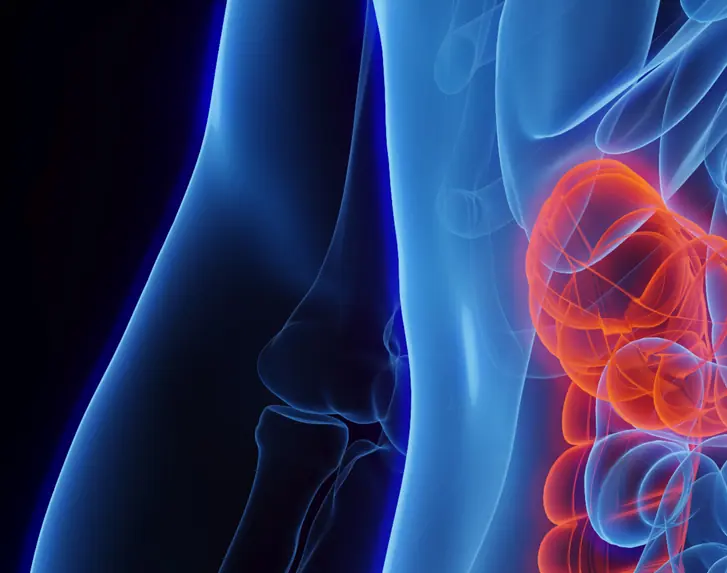 Colon cancer kills around 50,000 Americans a year. Credit: SEBASTIAN KAULITZKI/SCIENCE PHOTO LIBRARY/Getty