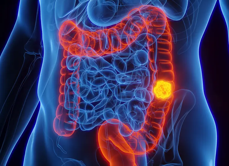 Mom diagnosed with colon cancer at 44 shares the 4 major symptoms she experienced - Article Image 1