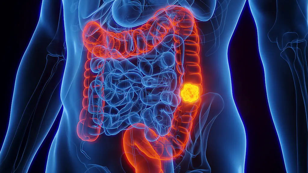 She was diagnosed with colon cancer at just 20 years old. Credit: SEBASTIAN KAULITZKI/SCIENCE PHOTO LIBRARY/Getty Images