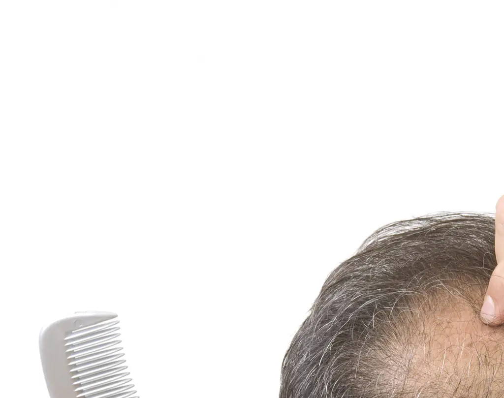 The tribunal ruled that it counted as sexual harassment because baldness is primarily associated with men rather than women. Credit: herkisi/Getty Images