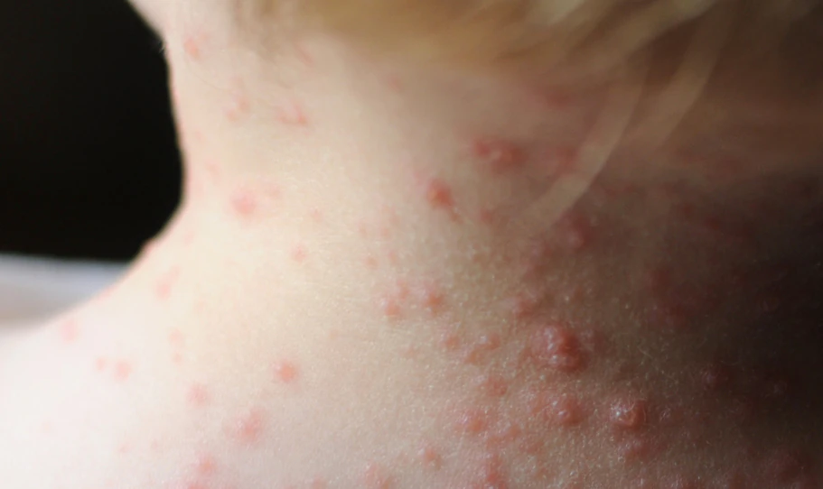 Parents of Texas girl, 6, who died of measles stand by decision to not vaccinate her