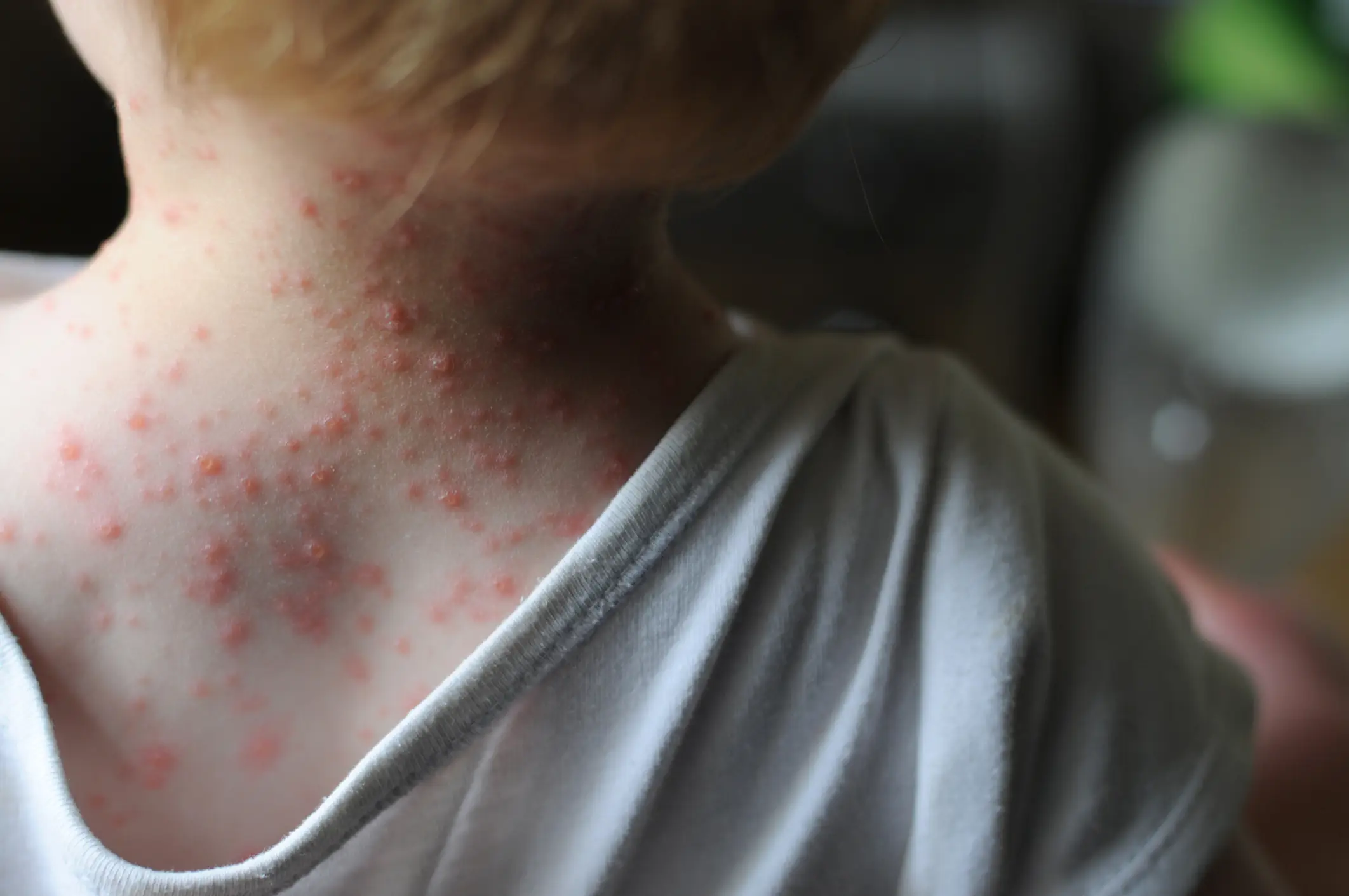 Parents of Texas girl, 6, who died of measles stand by decision to not vaccinate her