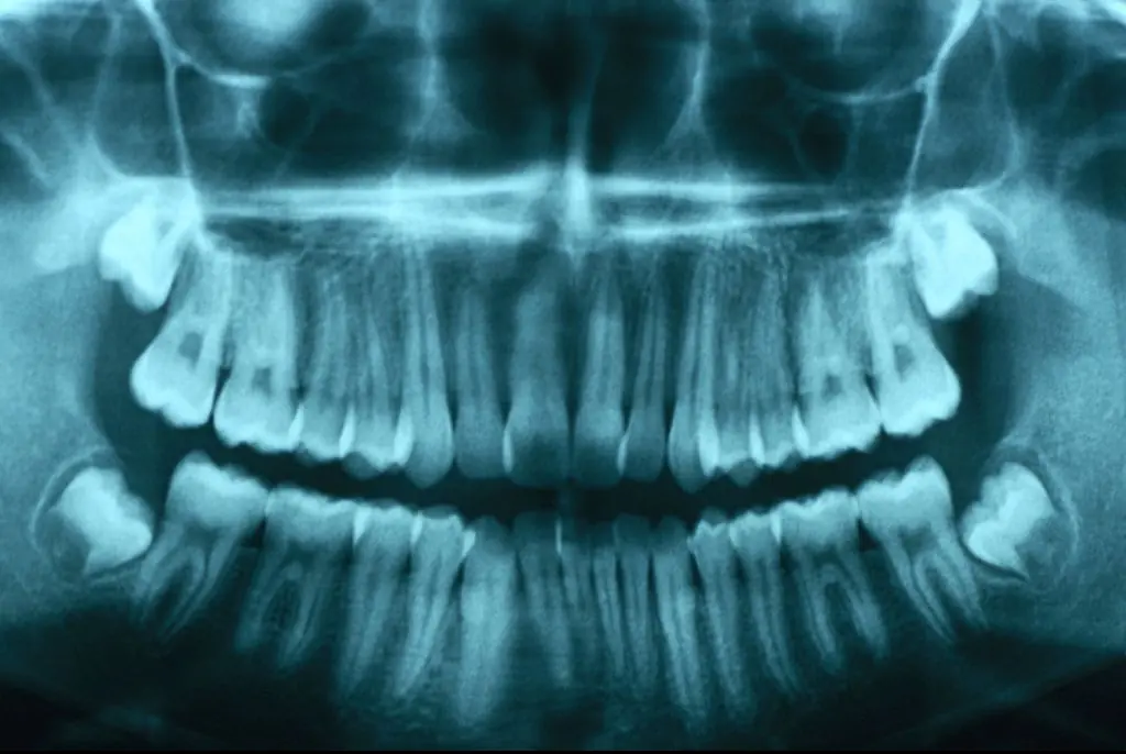 Woman, 23, issues urgent warning as she reveals she nearly died after common issue with wisdom tooth