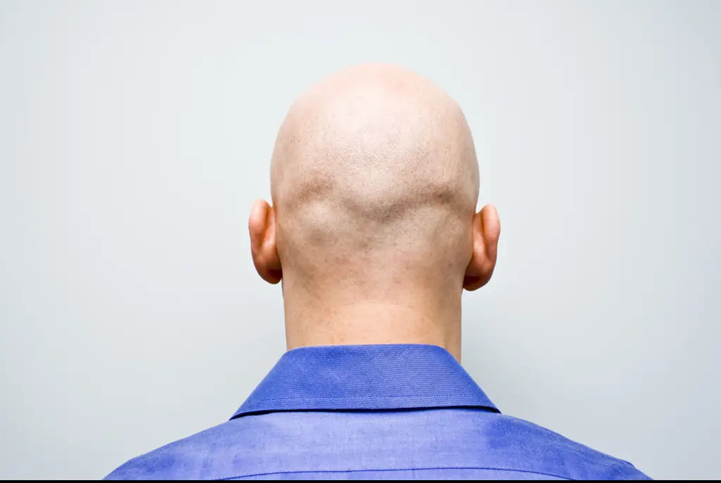 Calling a man 'bald' can be considered sexual harassment, High Court rules