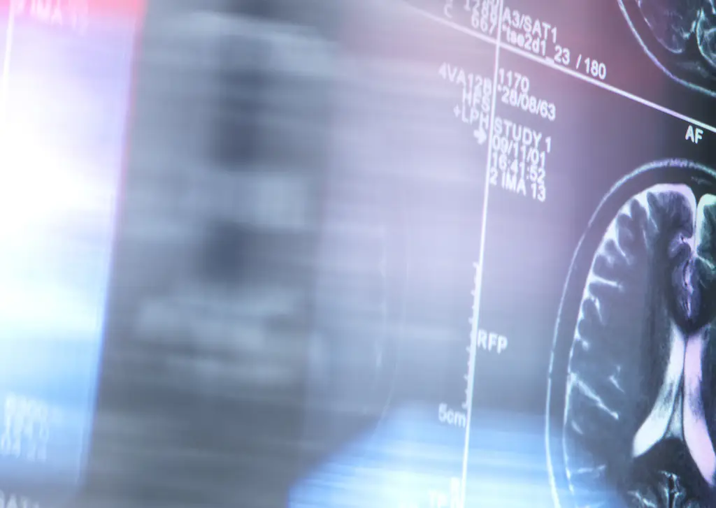 Man, 41, diagnosed with young onset Alzheimer's disease shares the early symptoms he experienced