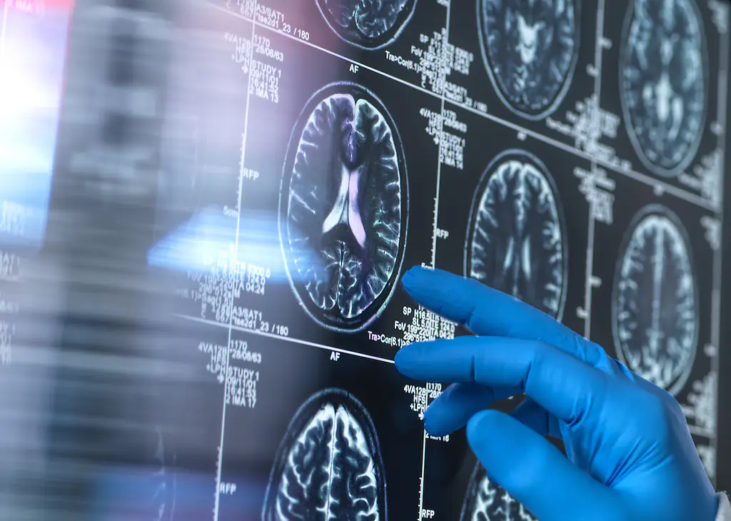 Dementia is commonly seen in the elderly, but can present at a young age, too. Credit: TEK IMAGE/SCIENCE PHOTO LIBRARY/Getty Images