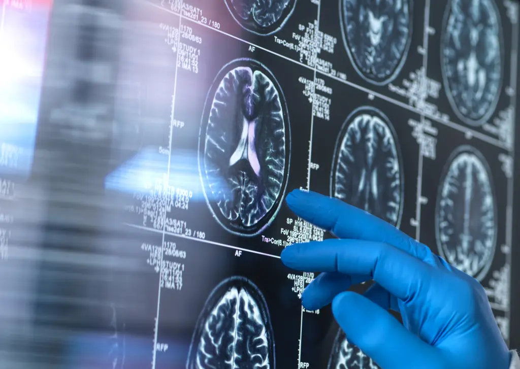 Man, 41, diagnosed with young onset Alzheimer's disease shares the early symptoms he experienced