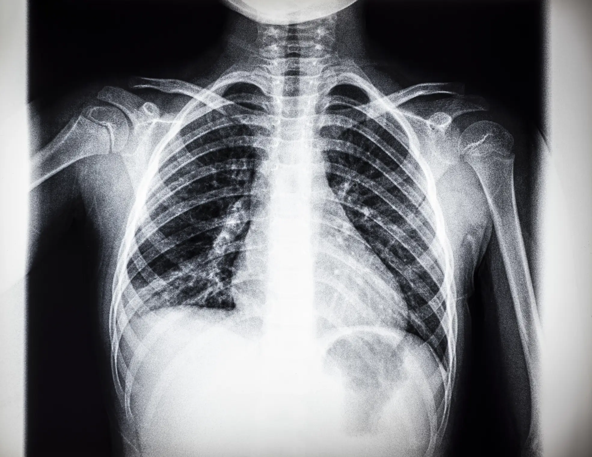 Man goes to hospital because his nipple is leaking pus: Doctors make horrifying discovery