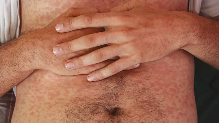 Measles