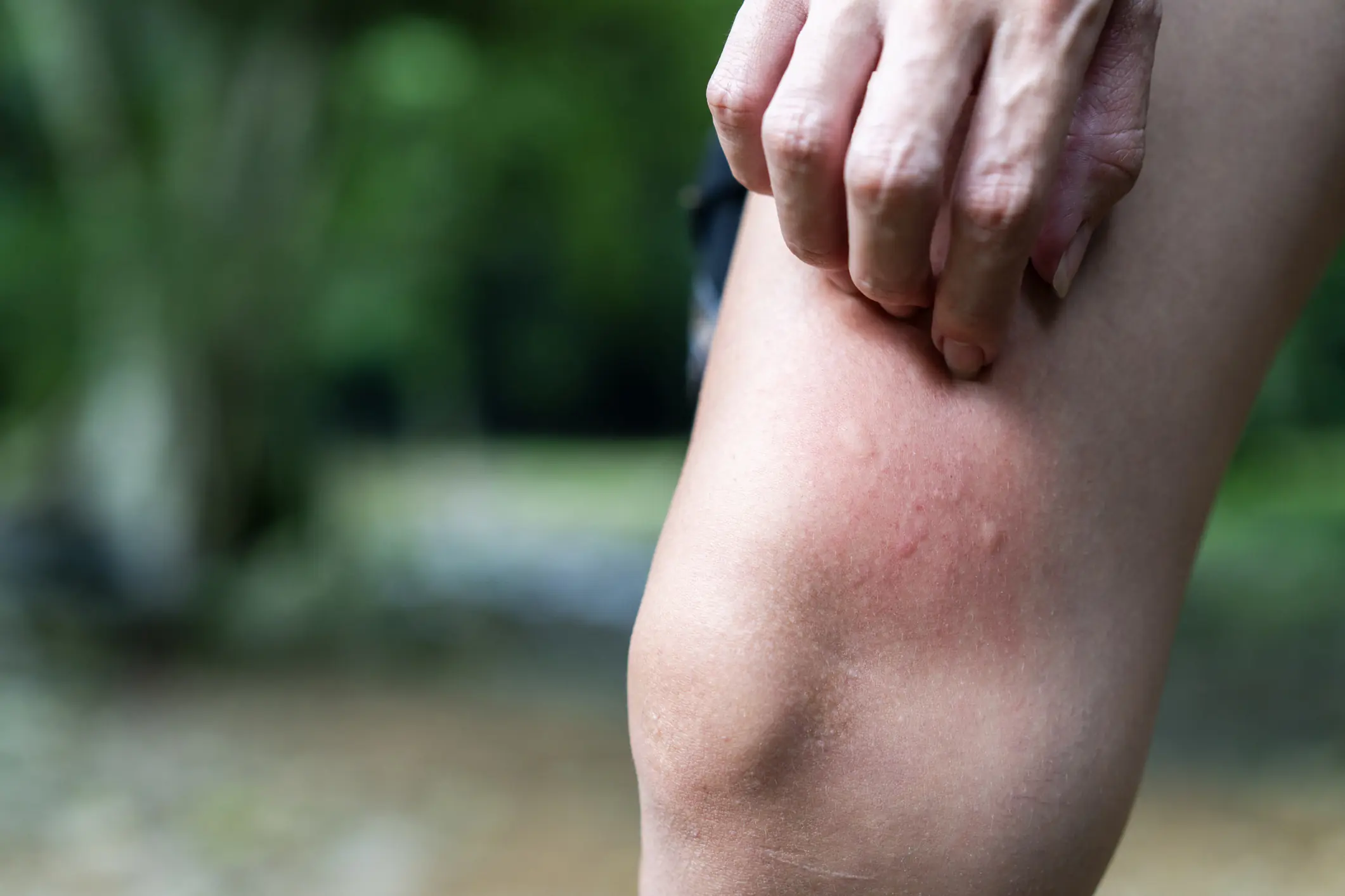Scientific reason some people get bitten by mosquitos more than others