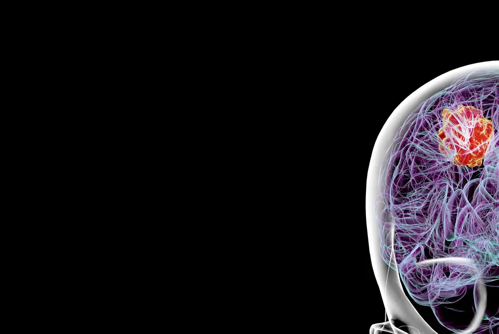 Doctor reveals the five common warning signs of deadly brain tumor that has just a 15-month average life expectancy