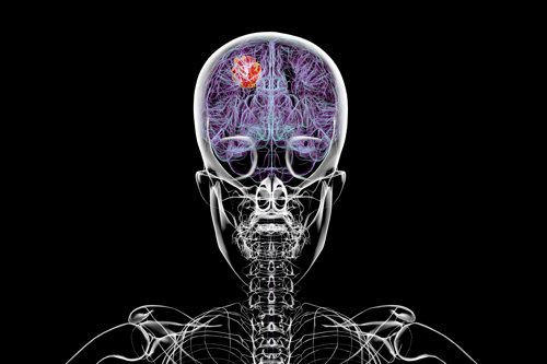 Doctor reveals the five common warning signs of deadly brain tumor that has just a 15-month average life expectancy