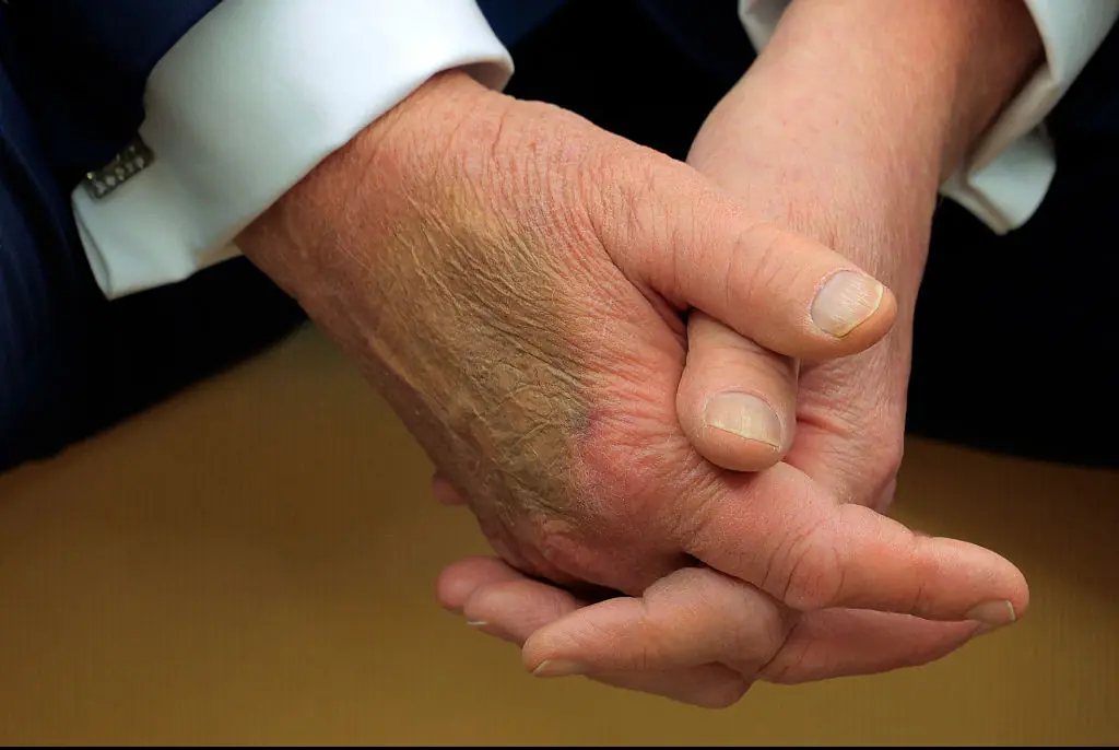 Donald Trump hand. Credit: Chip Somodevilla / Getty