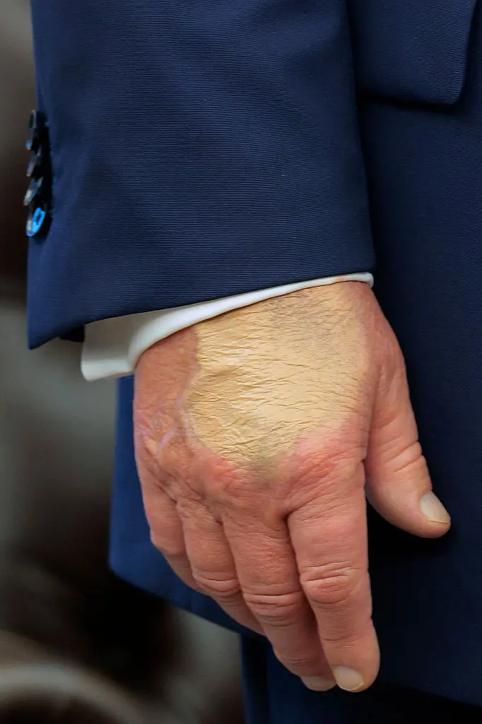 Makeup on Donald Trump's hand has caused intrigue. Credit: Chip Somodevilla / Getty