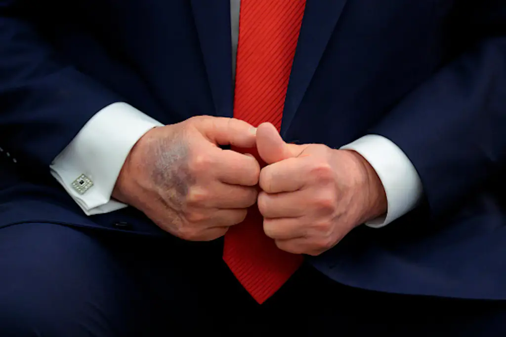 Donald Trump's hands were pictured bruised earlier this year. Credit: Chip Somodevilla/Getty Images.