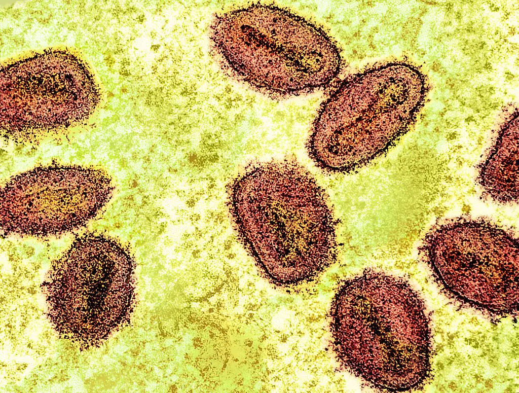 The mpox virus has some symptoms that should not be ignored. Credit: NIH-NIAID/Image Point FR/BSIP/Universal Images Group via Getty Images