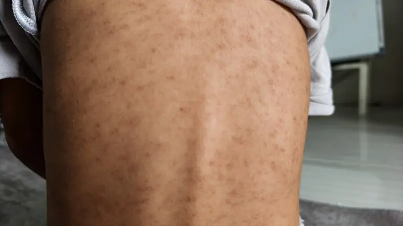 More than 100 children were possibly exposed to measles at an educational enrichment program. Credit: Fajrul Islam / Getty