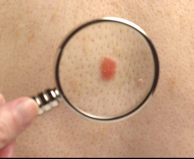 Doctor shares disturbing video of most severe skin cancer he's encountered and issues urgent health warning - Article Image 1