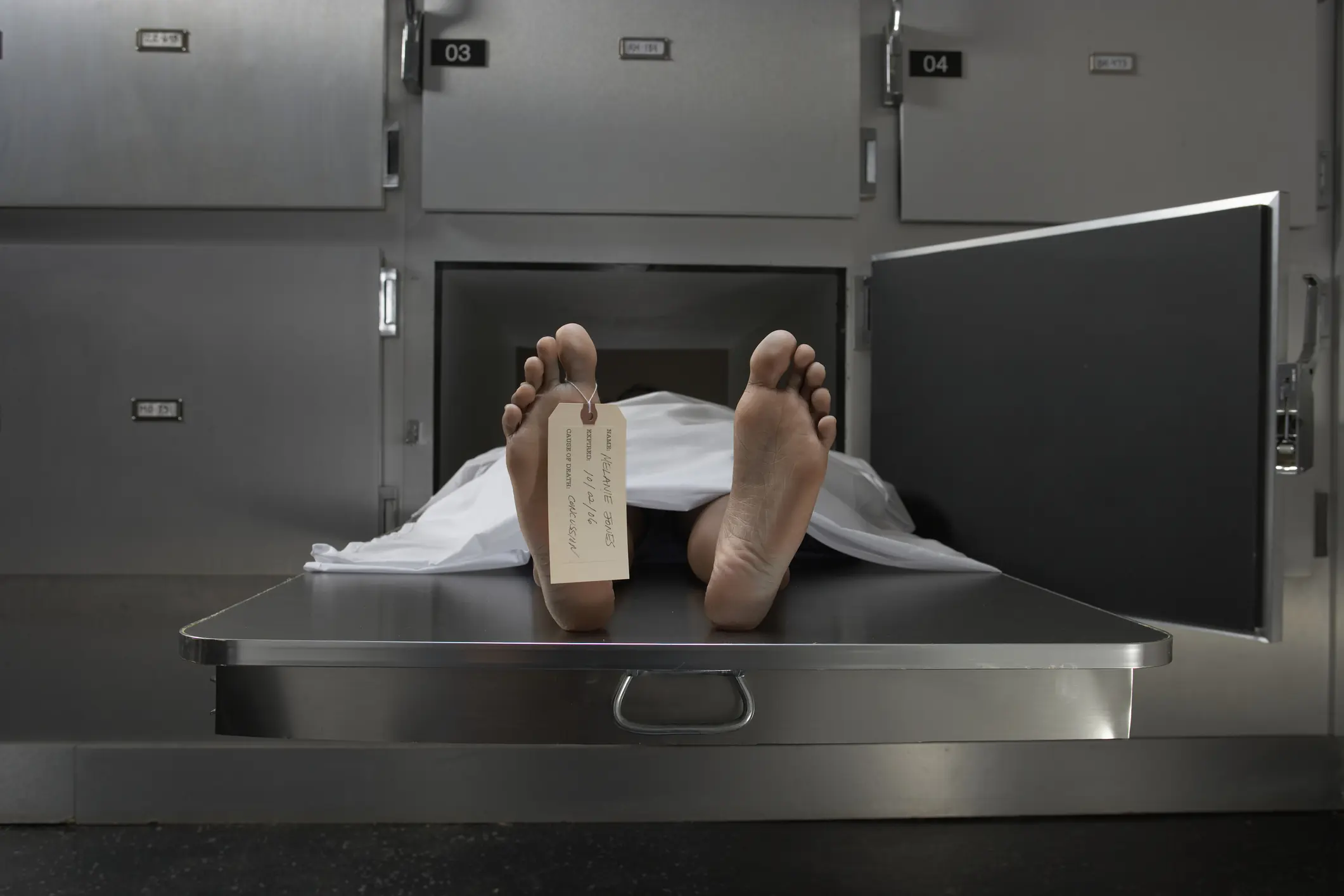 Mortuary worker explains the scientific reason why people seem to develop bruises after they die