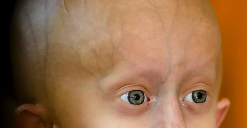 TikTok star Beandri Booysen dies at 19 from rare aging disease