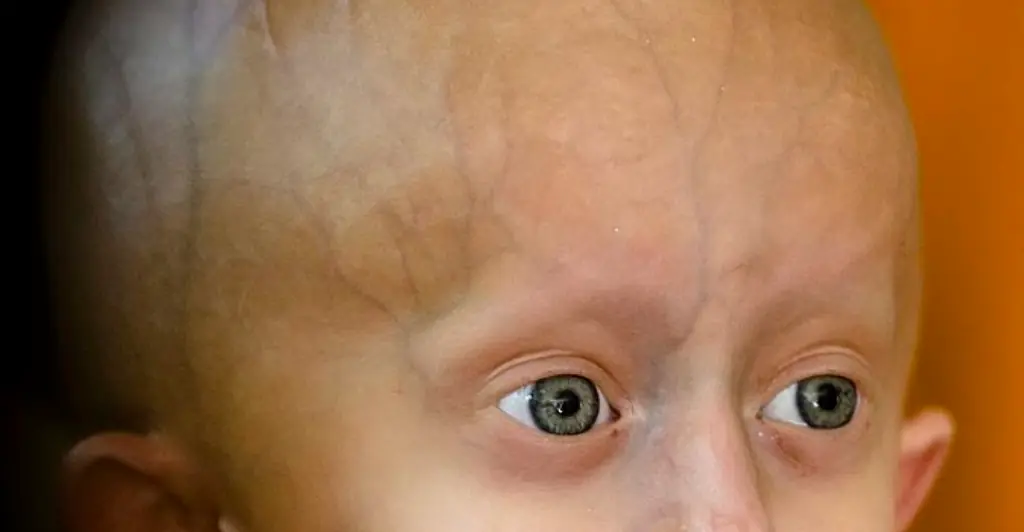 TikTok star Beandri Booysen dies at 19 from rare aging disease