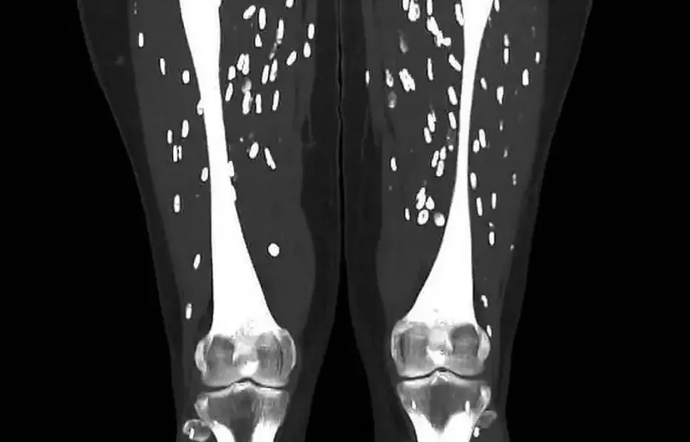 Doctor shares horrifying scan showing patient's legs after eating undercooked pork