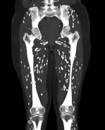 Doctor shares horrifying scan showing patient's legs after eating undercooked pork