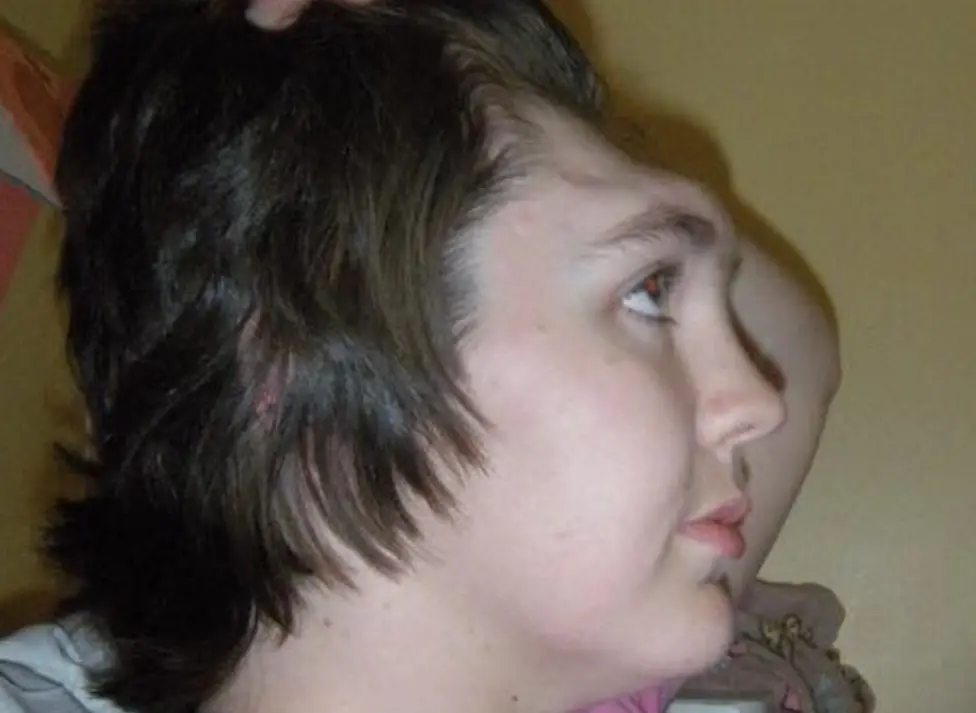 Woman who lost her entire forehead issued stark warning to people who put their feet on the dashboard