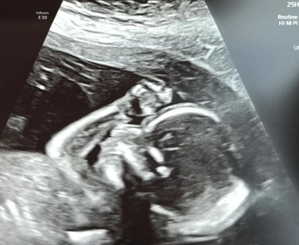 The sonogram with the OBGYN removed. Credit: Phillip Faraone/Getty